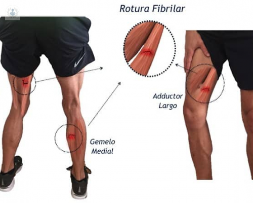 Rotura muscular: bíceps femoral