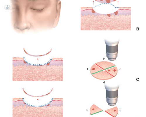 la-microcirugia-de-mohs-procedimiento-y-post-operatorio imagen de artículo