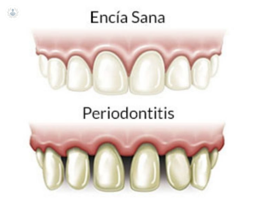 Prevención y tratamiento de la Periodontitis