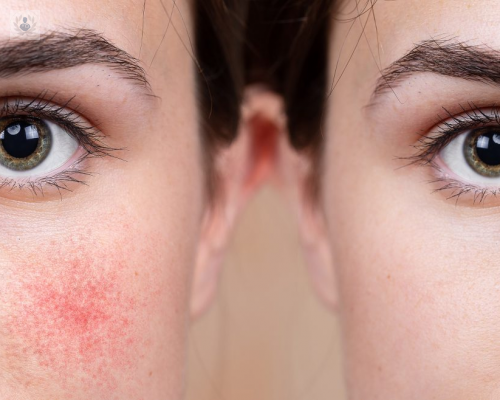 tratamiento-de-la-cuperosis-y-las-aranas-vasculares imagen de artículo