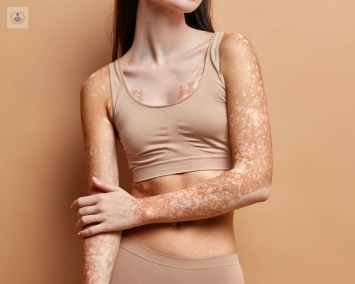 el-vitiligo imagen de artículo
