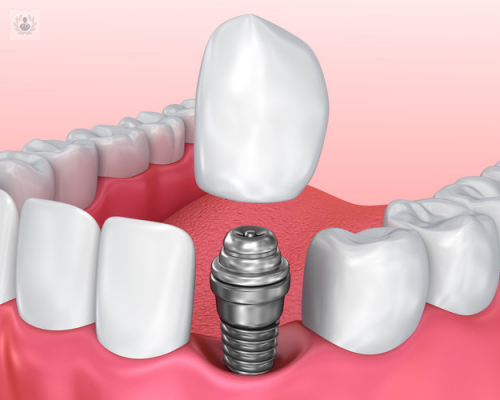 mantenimiento-de-implantes imagen de artículo