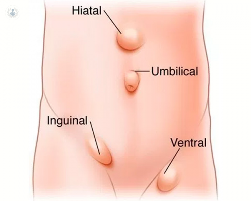 La pared abdominal: hernia y eventración