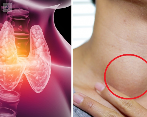 bocio-causas-sintomas-y-tratamiento imagen de artículo