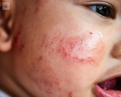 brotes-dermatitis-en-ninos imagen de artículo