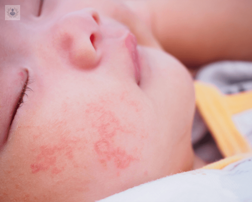 Decálogo para niños con dermatitis atópica