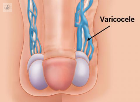 varicocele-causa-de-infertilidad-masculina imagen de artículo