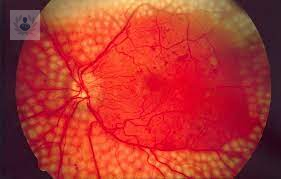 Un diagnóstico precoz, clave en la retinopatía diabética