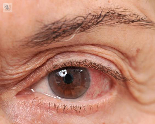 desprendimiento-de-retina imagen de artículo