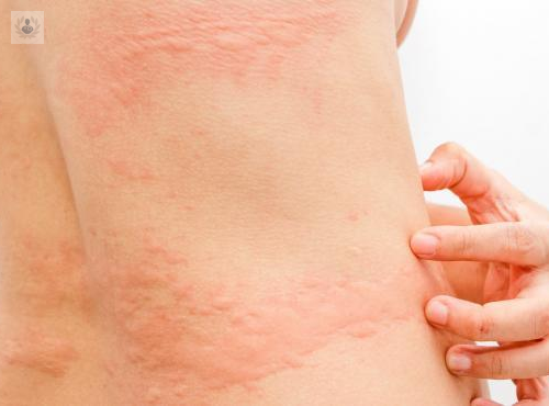 urticaria-sintomas-y-tratamiento imagen de artículo