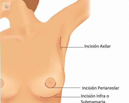 aumento-de-mamas-sin-cicatriz-visible imagen de artículo