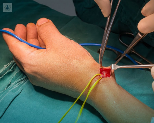 fistula-arteriovenosa-causas-y-tratamiento imagen de artículo