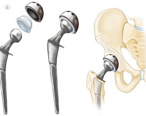recambio-de-protesis-de-cadera-el-dolor-es-la-senal-de-alarma imagen de artículo