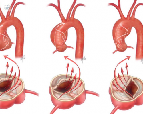“La raíz aórtica es la porción más proximal a la principal arteria del cuerpo, la aorta”