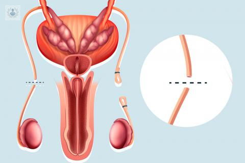 la-vasectomia-sin-bisturi-es-considerada-la-mejor-tecnica-de-la-actualidad imagen de artículo