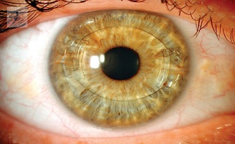 Preguntas frecuentes sobre las lentes intraoculares