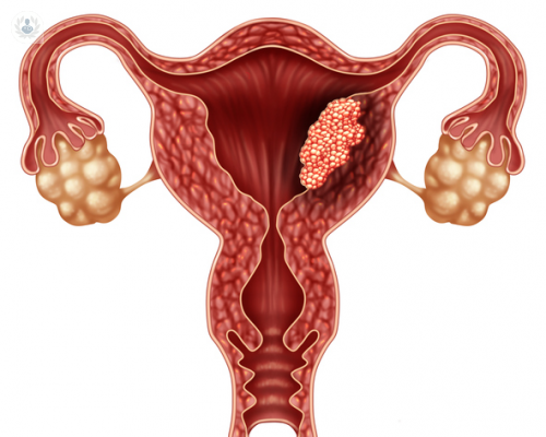 Extirpación de pólipos endometriales