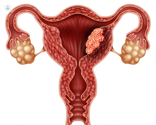 extirpacion-de-polipos-endometriales imagen de artículo