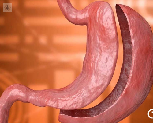 tubo-gastrico-la-reduccion-de-estomago-sin-cicatrices imagen de artículo