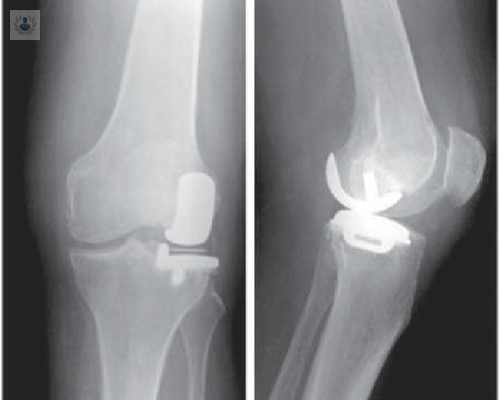 protesis-unicompartimentales-de-rodilla imagen de artículo