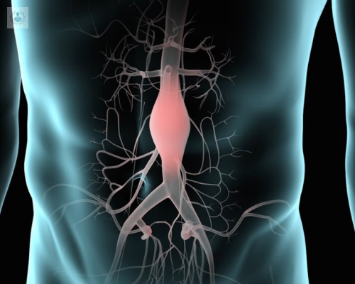 Aneurisma de aorta: cómo detectarlos y tratarlos