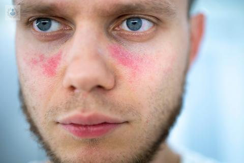 el-lupus-eritematoso-una-patologia-genetica imagen de artículo
