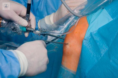 La Artroscopia de Rodilla frente a la cirugía convencional
