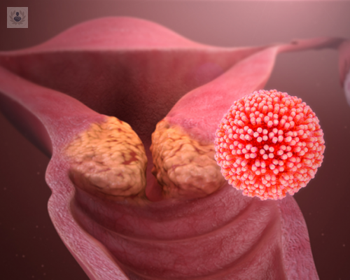 el-virus-del-papiloma-humano-y-su-prevencion imagen de artículo