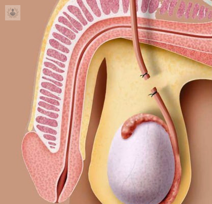 vasectomia-un-metodo-irreversible imagen de artículo