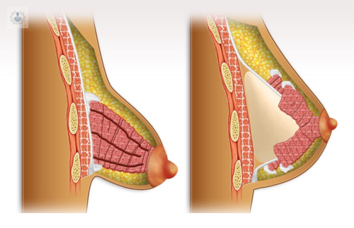 operacion-de-mamas-tuberosas imagen de artículo