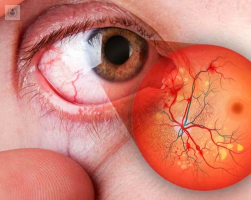 Edema macular, una enfermedad indolora