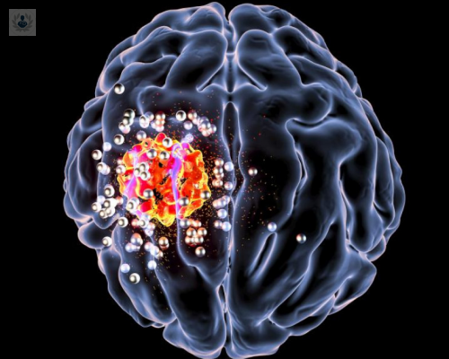tumores-del-sistema-nervioso imagen de artículo