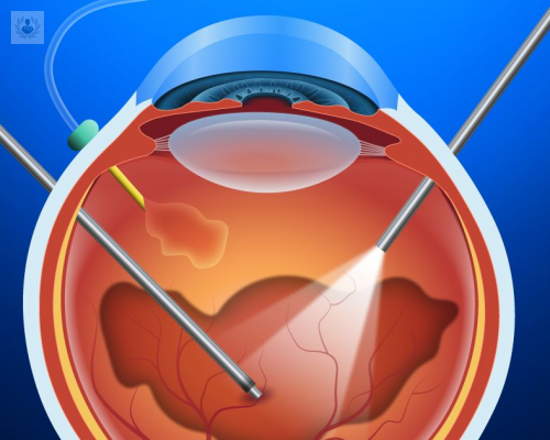 vitrectomia-una-tecnica-con-la-que-hay-que-ir-con-ojo imagen de artículo