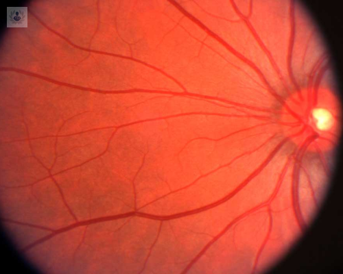 Retinopatía diabética, una enfermedad que puede provocar pérdida irreversible de la visión