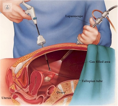 laparoscopia-e-histeroscopia-tecnicas-endoscopicas-de-la-ginecologia imagen de artículo