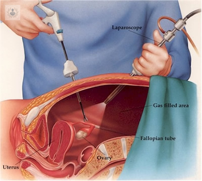 Laparoscopia e histeroscopia: técnicas endoscópicas de la ginecología