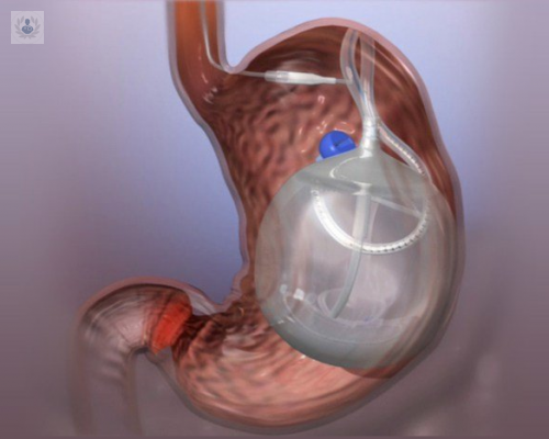 balon-intragastrico-un-buen-metodo-para-perder-peso imagen de artículo
