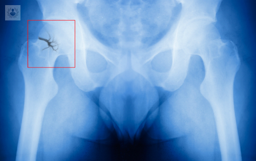 fracturas-de-cadera-sintomas-causas-y-tratamientos imagen de artículo