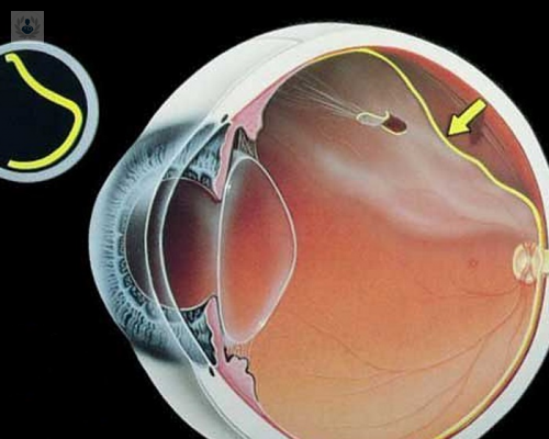 guia-del-desprendimiento-de-retina imagen de artículo