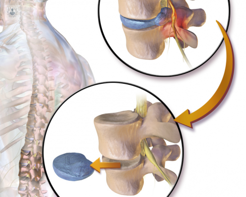 discectomia-lumbar imagen de artículo