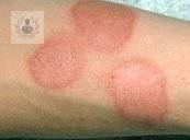 Dermatitis: el Eccema Numular, síntomas y tratamiento
