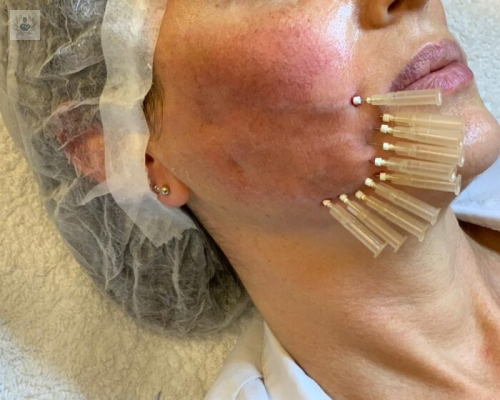 hilos-tensores-de-pdo-la-tecnica-no-agresiva-para-un-efecto-lifting imagen de artículo