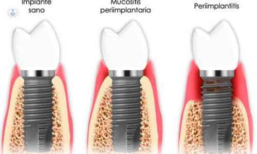 la-periimplantitis-que-es-por-que-se-produce-y-que-sintomas-presenta imagen de artículo