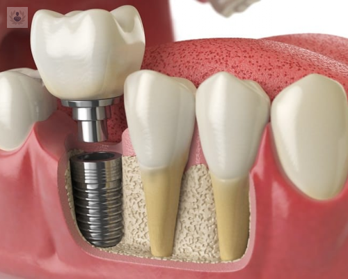 la-implantologia-una-solucion-para-la-perdida-dental imagen de artículo