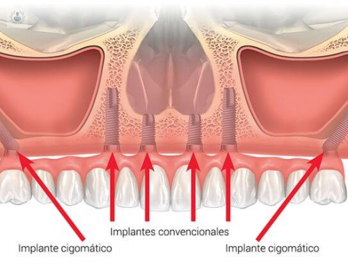 los-implantes-cigomaticos imagen de artículo