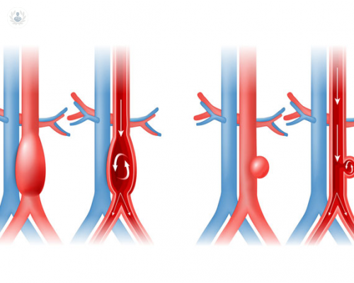 el-aneurisma-de-aorta-diagnostico-y-tratamiento imagen de artículo
