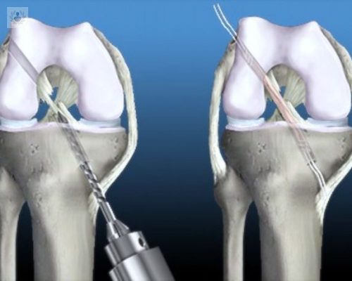 operacion-del-ligamento-cruzado-anterior imagen de artículo