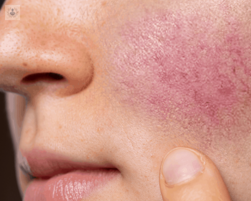 antes-y-despues-de-un-tratamiento-laser-de-rosacea imagen de artículo