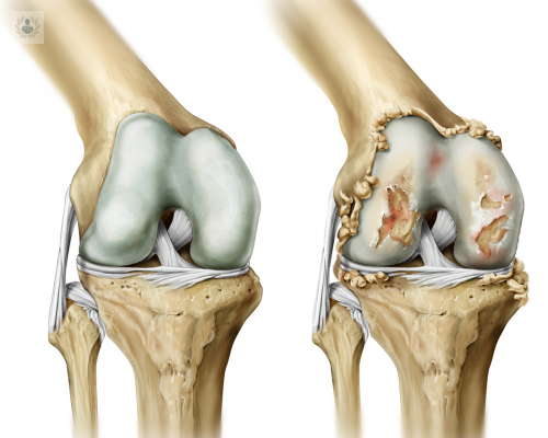 el-desafio-con-las-lesiones-graves-del-cartilago-de-la-rodilla imagen de artículo