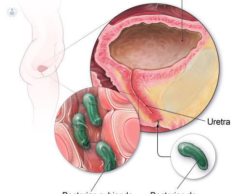 el-reto-de-las-infecciones-urinarias imagen de artículo